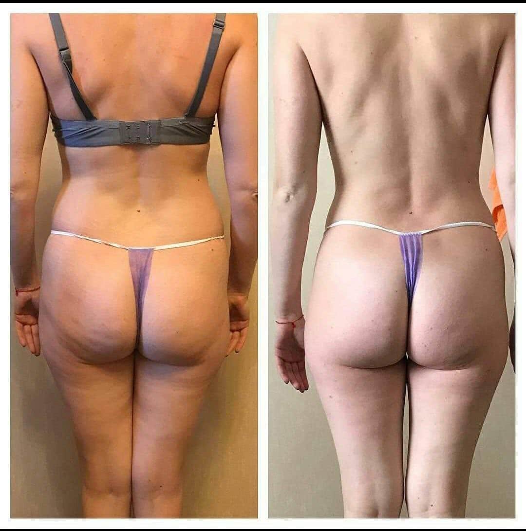 Fotograf&iacute;a de antes y despu&eacute;s de T-Shape 2