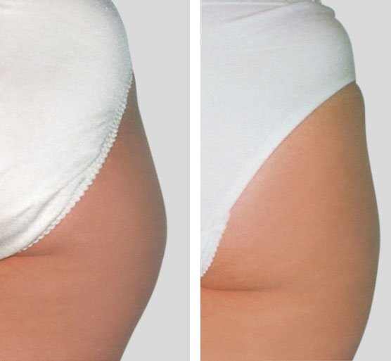 Ejemplo de resultado de un tratamiento T-Shape 2