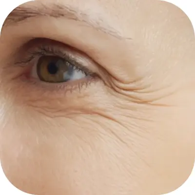 Ultherapy Ultraformer MPT Marbella / non surgical facelift