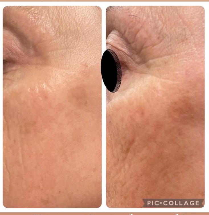 ESOSOMIC skin regeneration before and after three treatment sessions