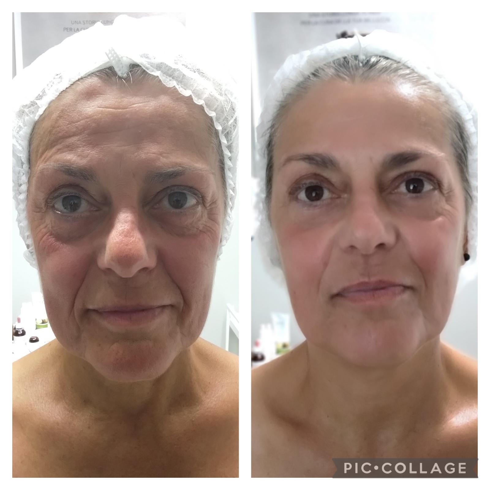 ESOSOMIC exosome skin treatment before and after six sessions