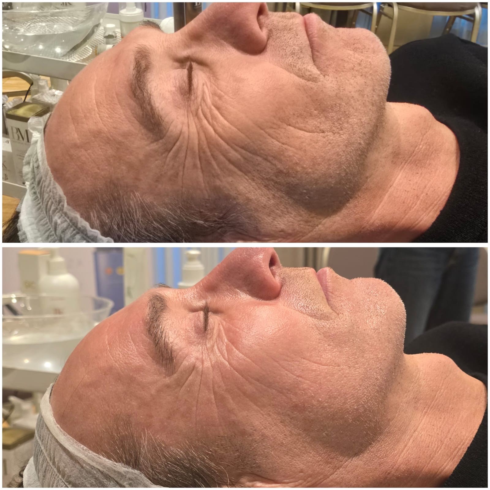 ESOSOMIC facial skin rejuvenation before and after one session