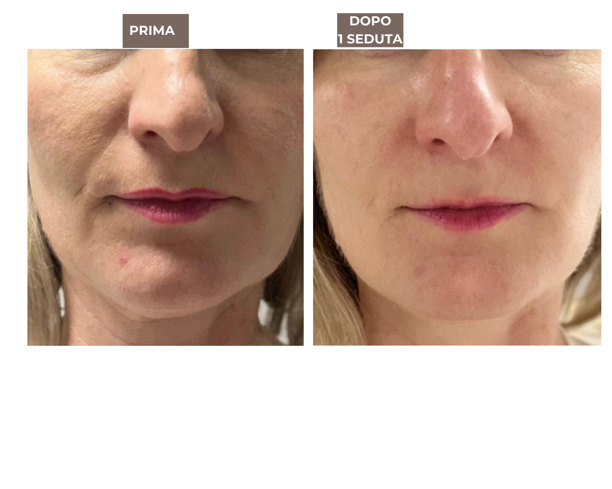 ESOSOMIC skin renewal treatment before and after comparison