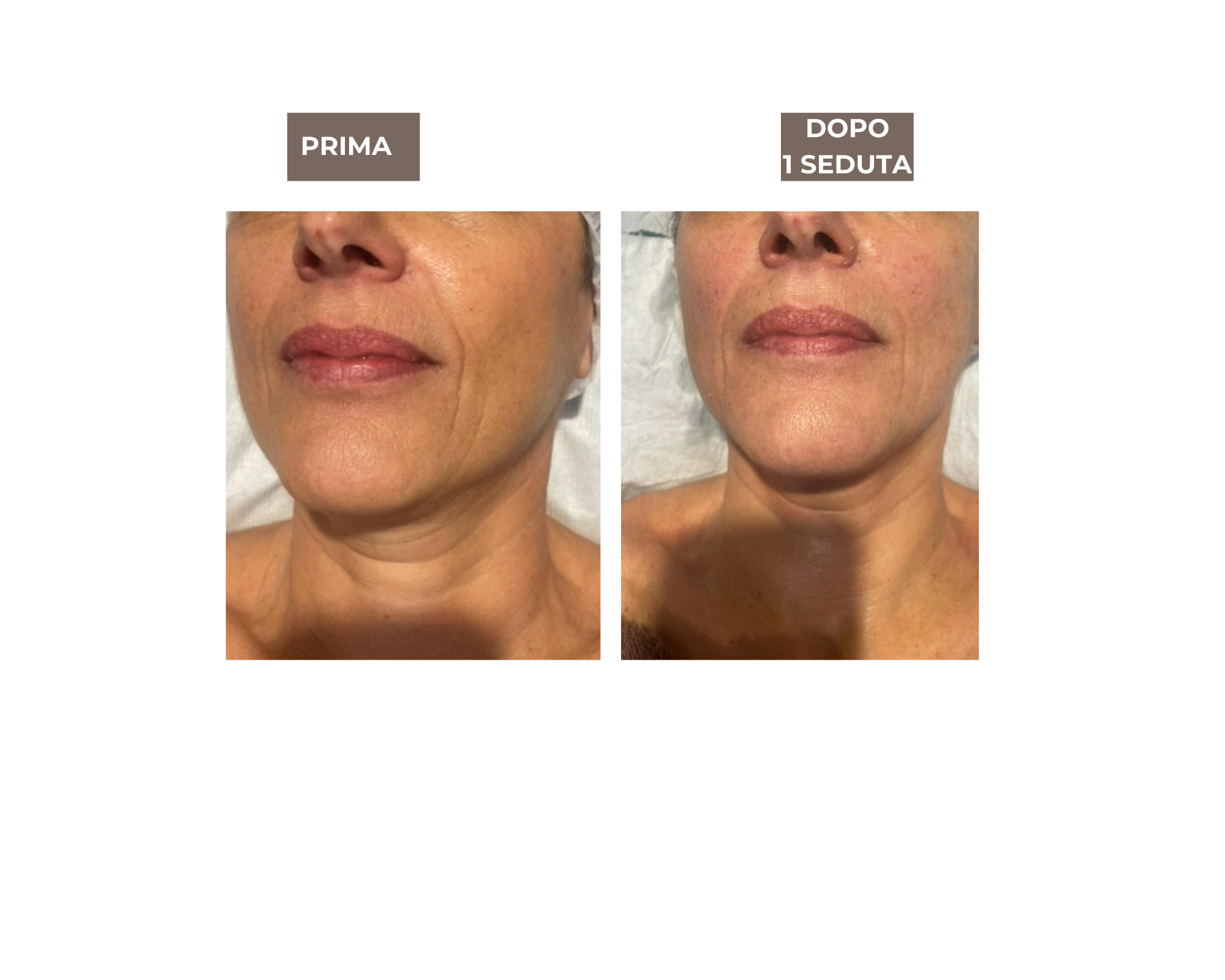 ESOSOMIC exosome rejuvenation treatment results at FBS Beauty